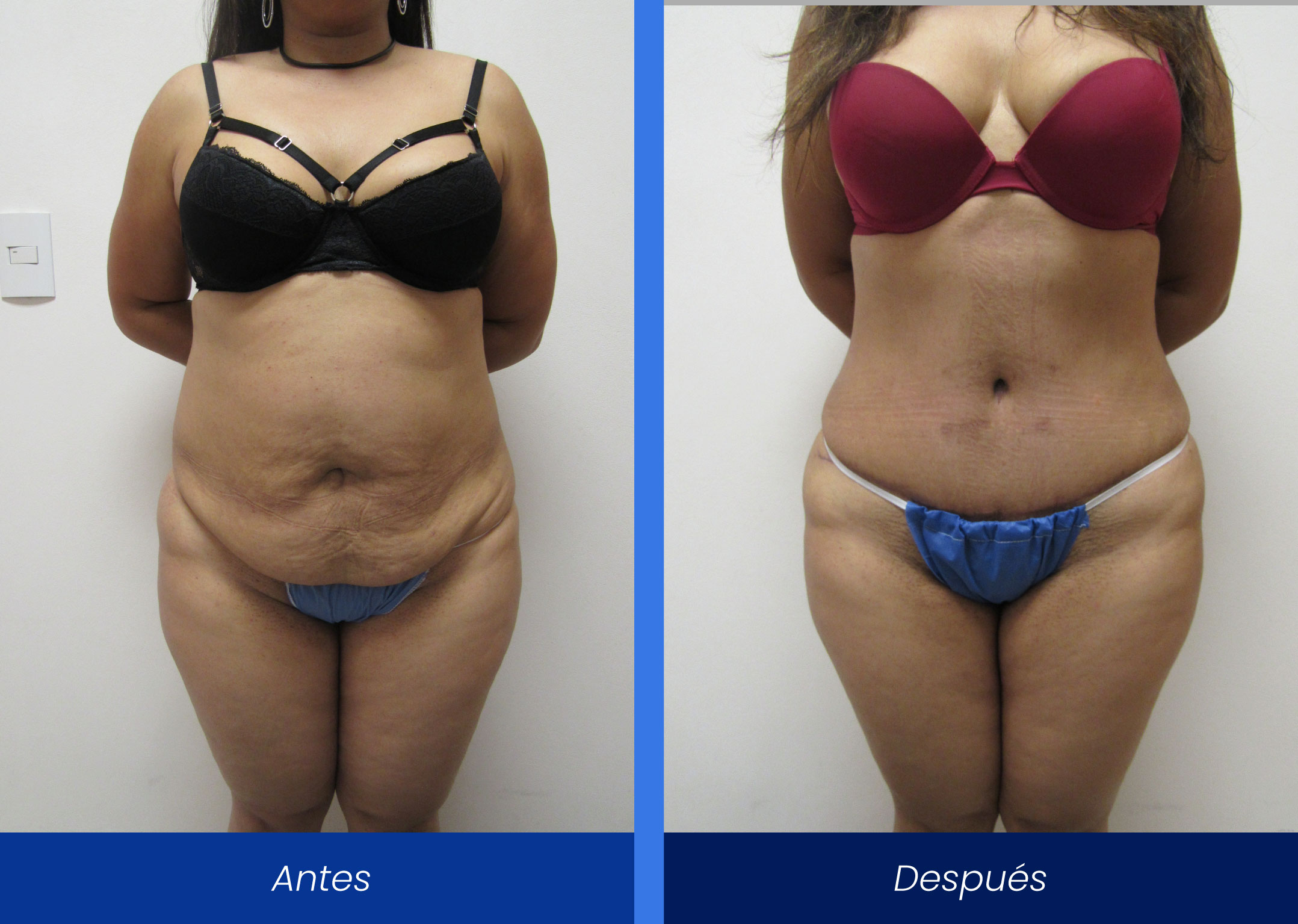 Abdominoplastía Abdominoplastía
