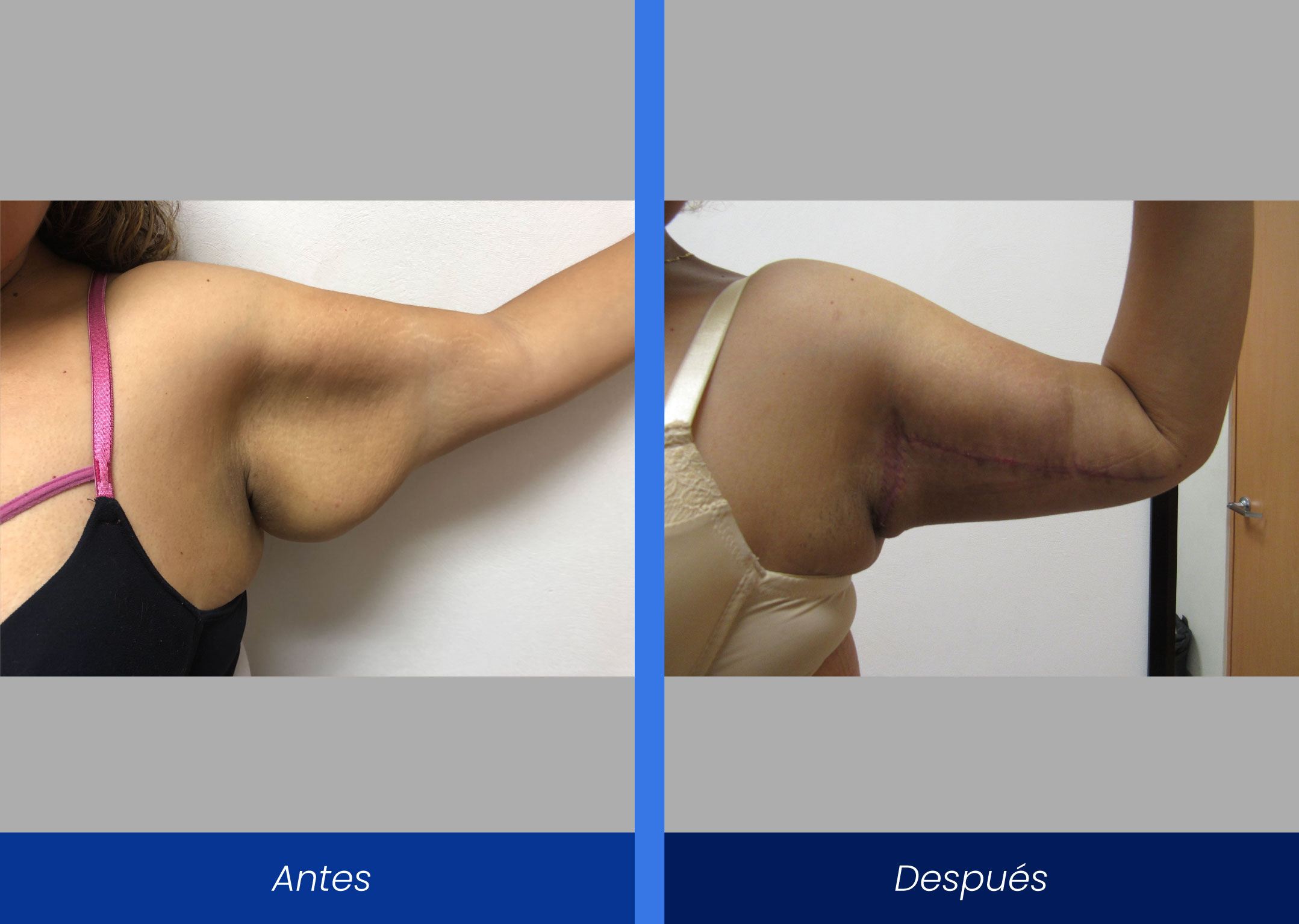 Braquiplastia Abdominoplastía