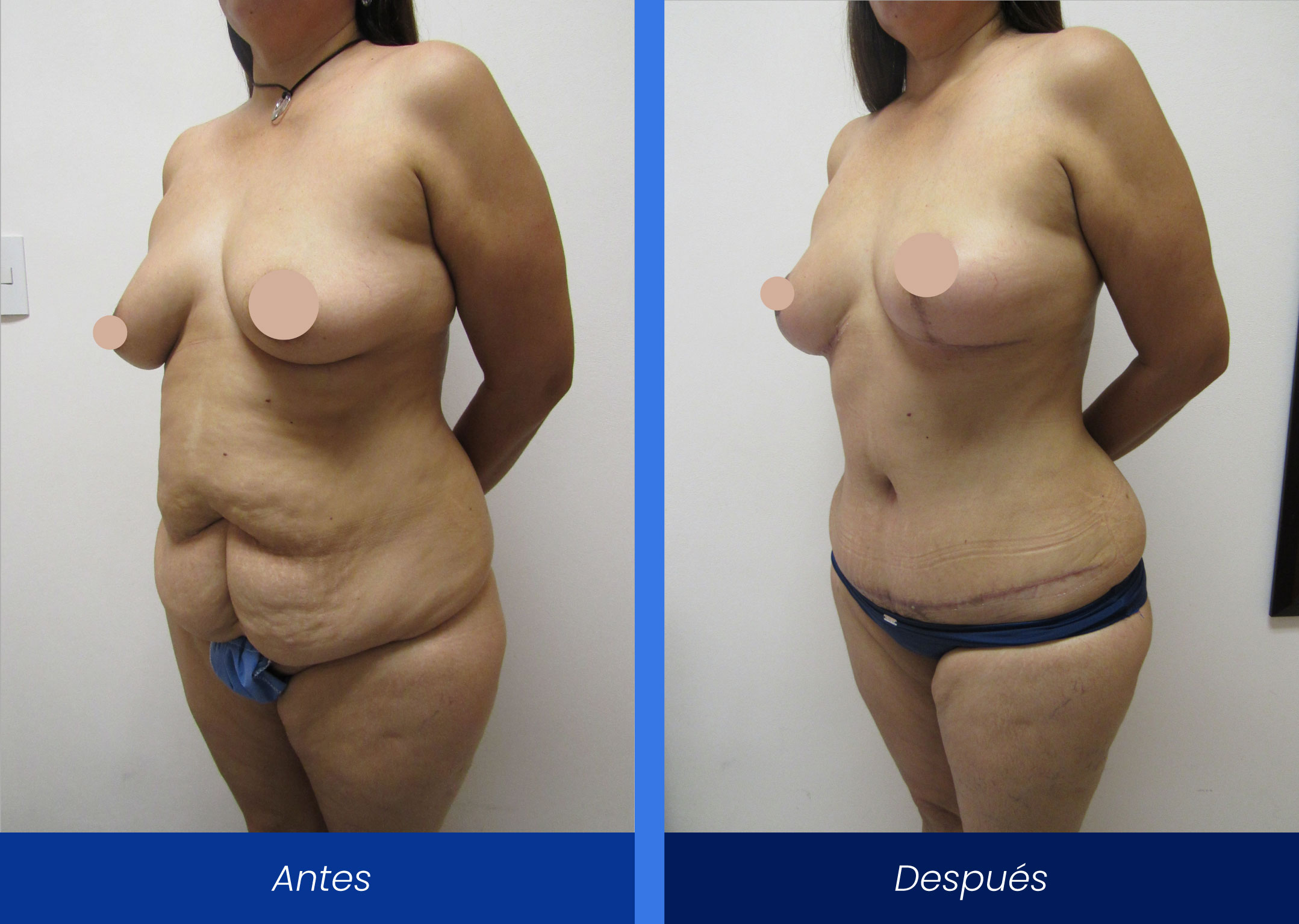 lipoabdominoplastia lipoabdominoplastia