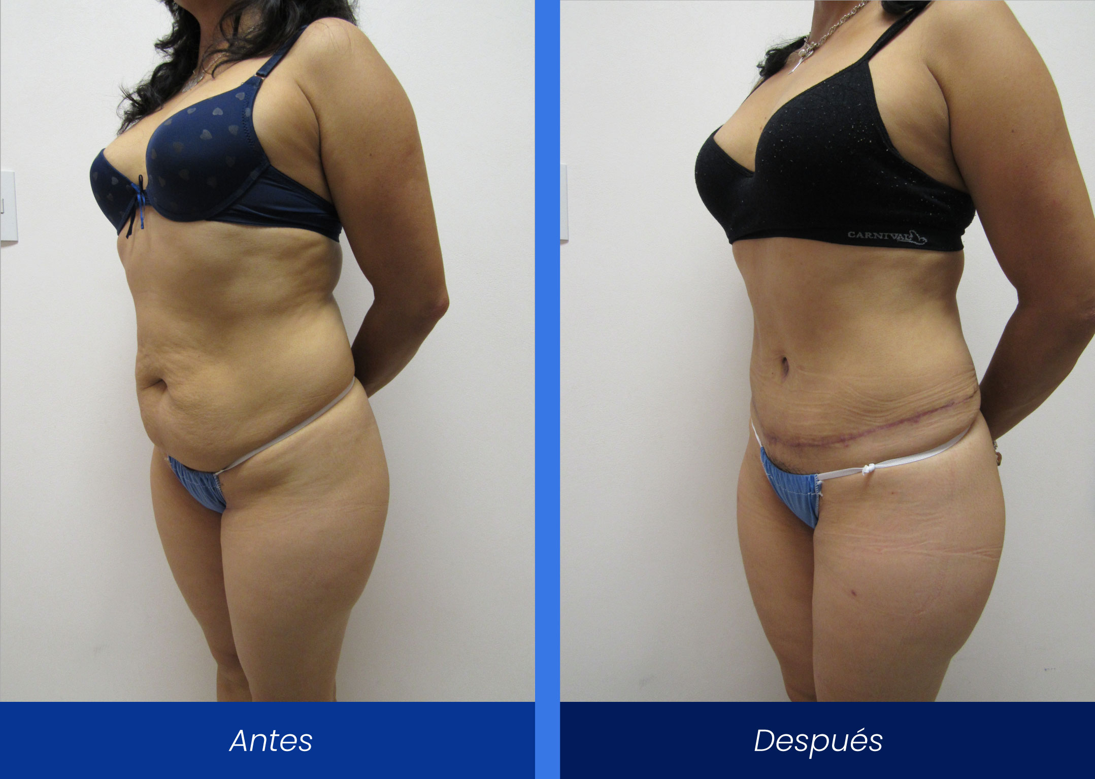 lipoabdominoplastia lipoabdominoplastia