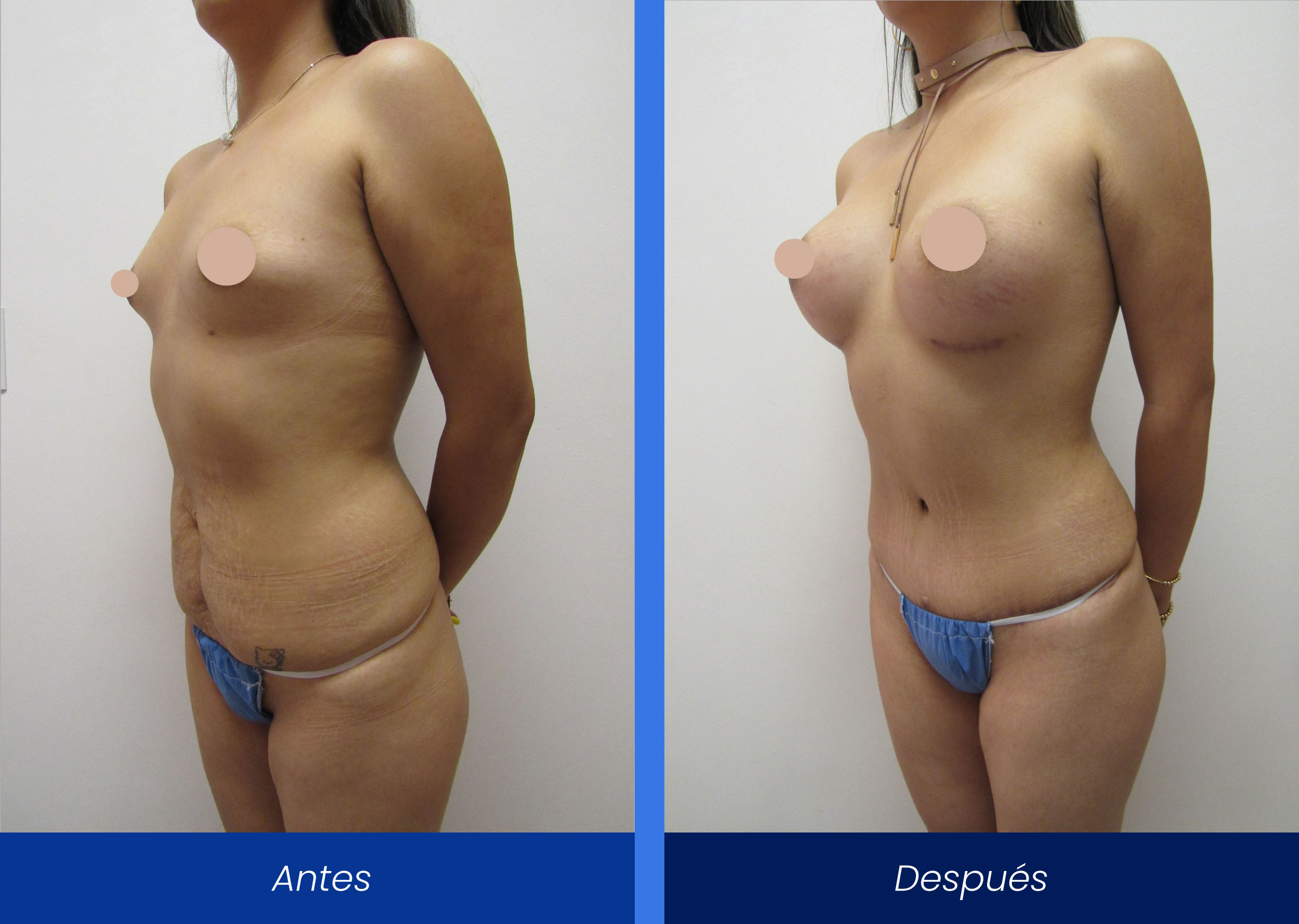 Lipoabdominoplastía-mamoplastía-de-aumento Lipoabdominoplastía-mamoplastía-de-aumento