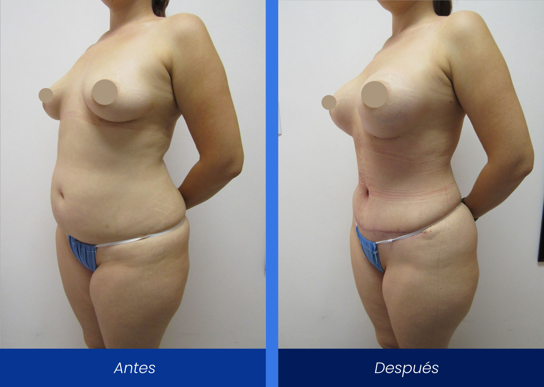Lipoabdominoplastía-mamoplastía-de-aumento Lipoabdominoplastía-mamoplastía-de-aumento