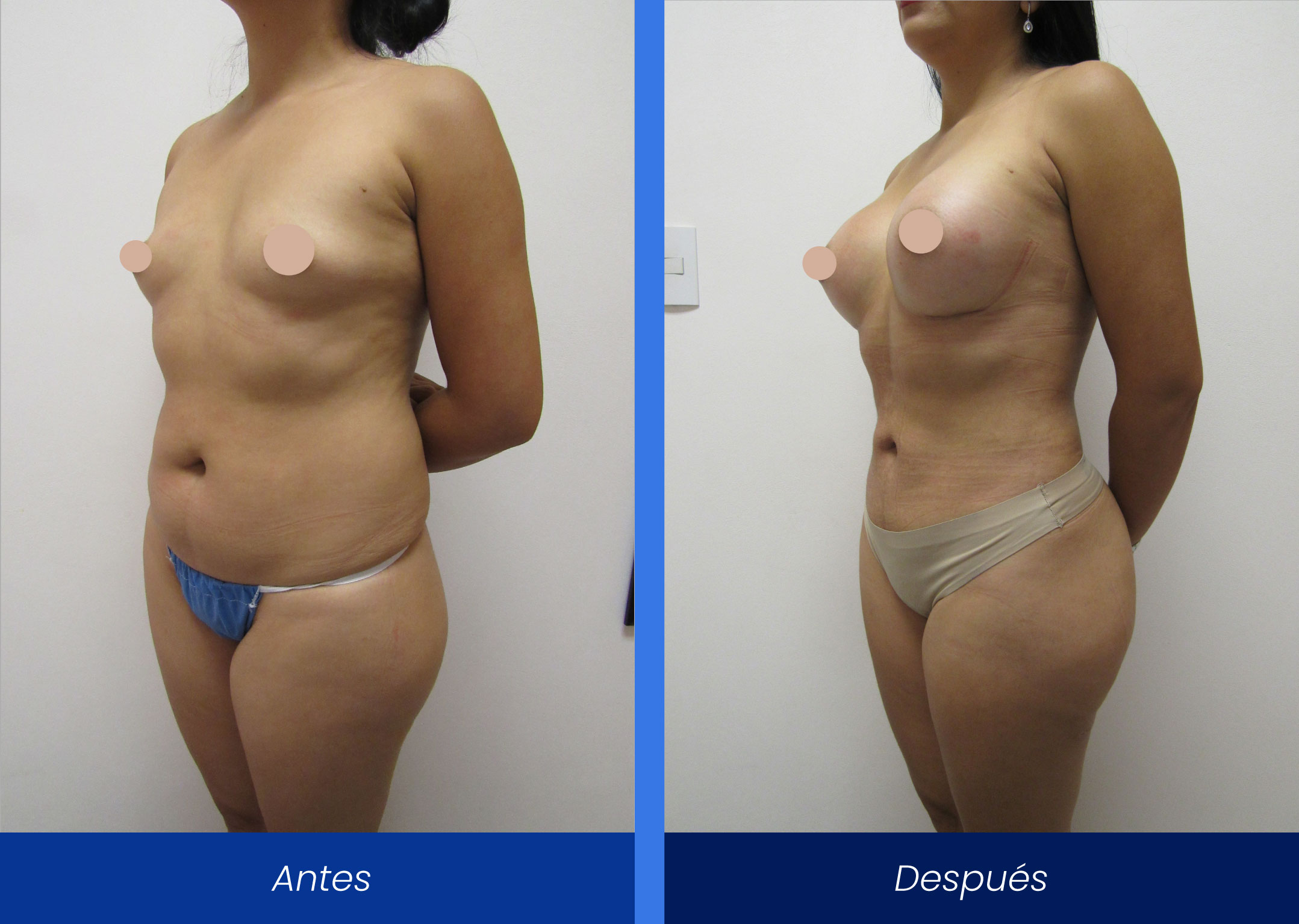 Liposucción mamoplastia aumento Liposucción mamoplastia aumento