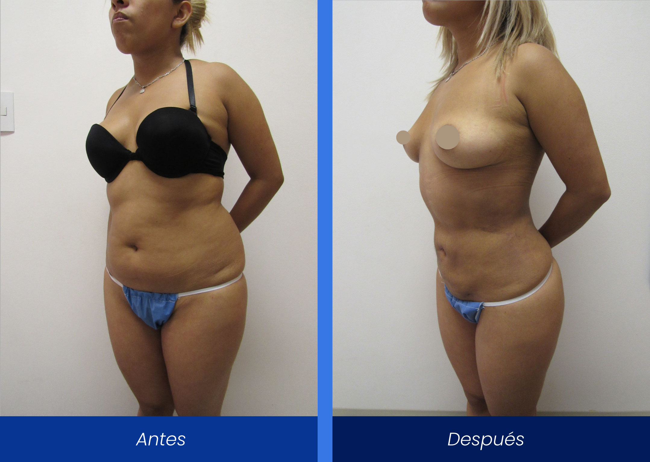Liposucción Liposucción