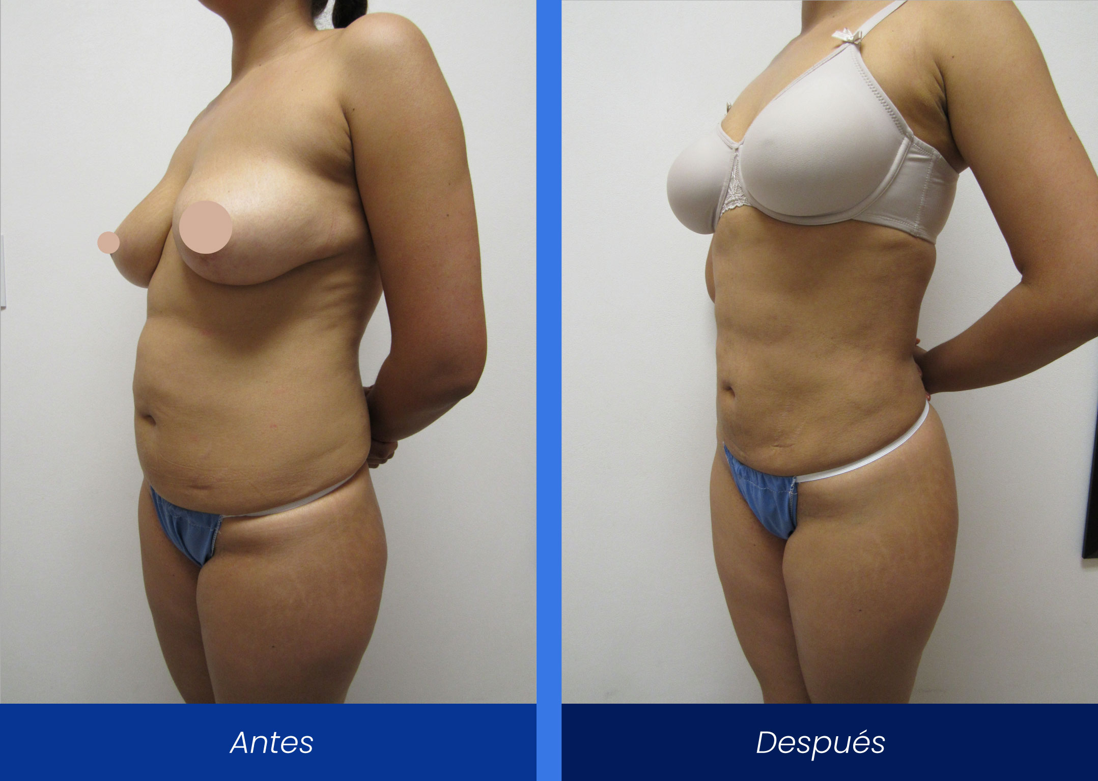 Liposucción Liposucción