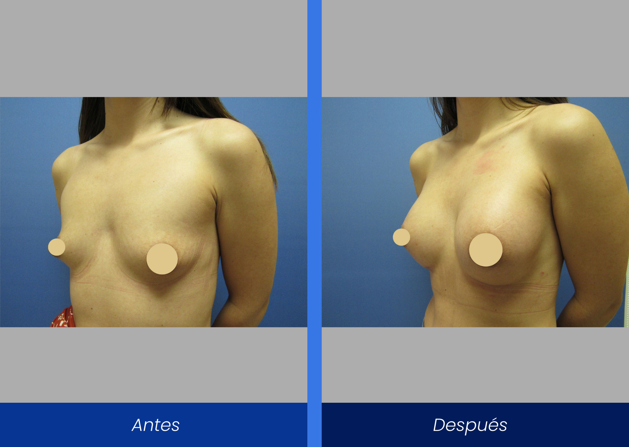 Mamoplastia de aumento Mamoplastia de aumento