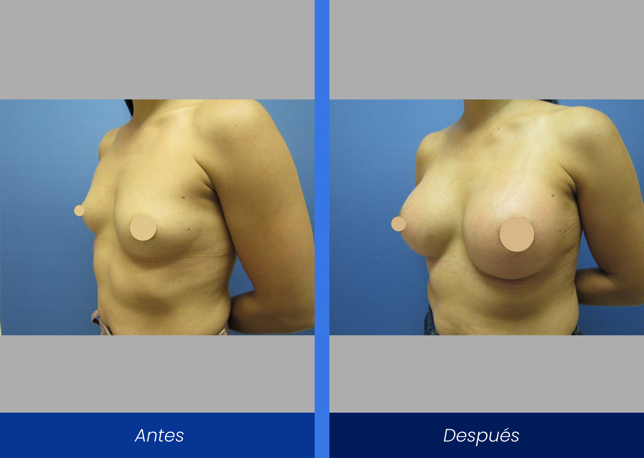 Mamoplastia de aumento Mamoplastia de aumento