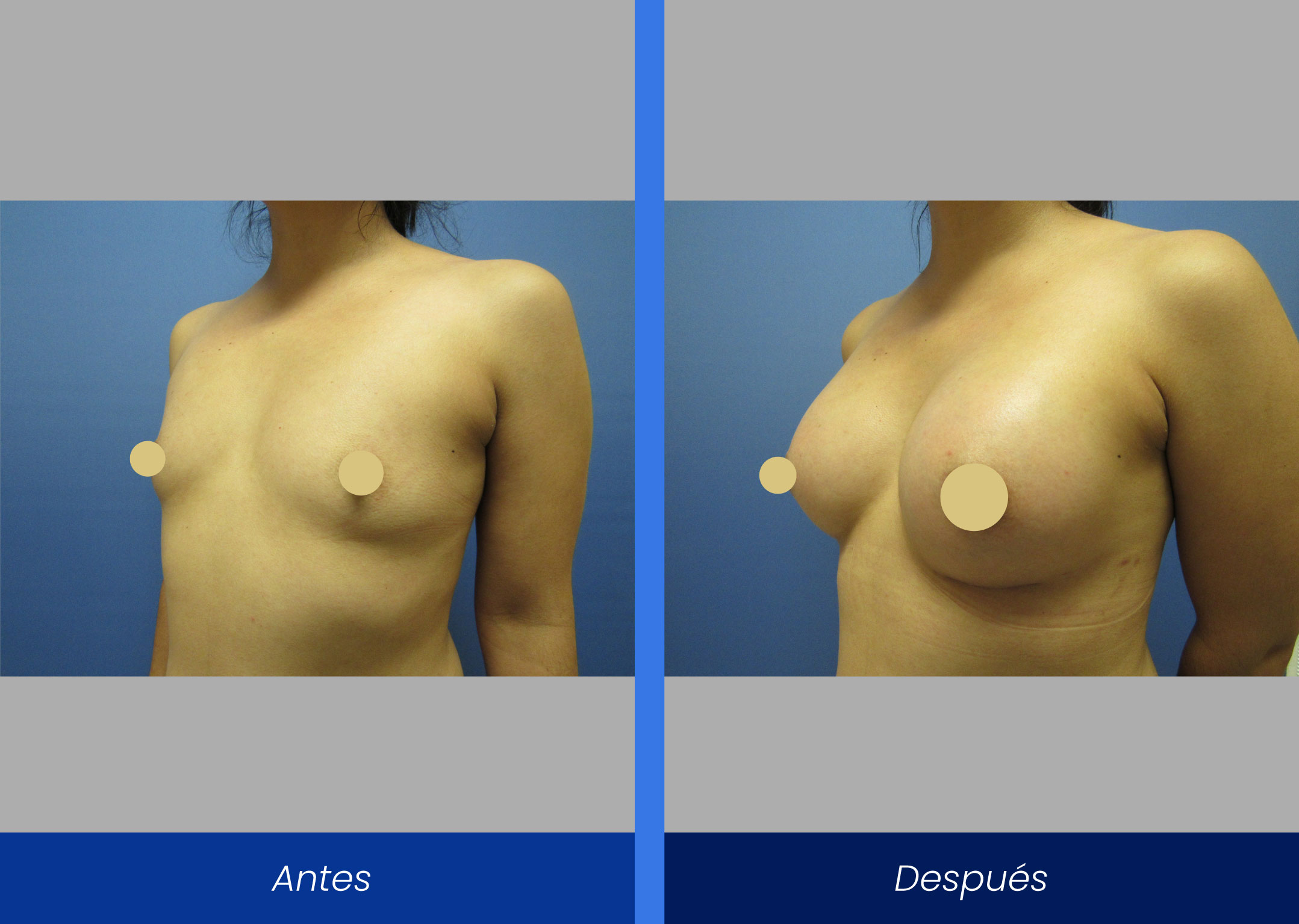 Mamoplastia de aumento Mamoplastia de aumento
