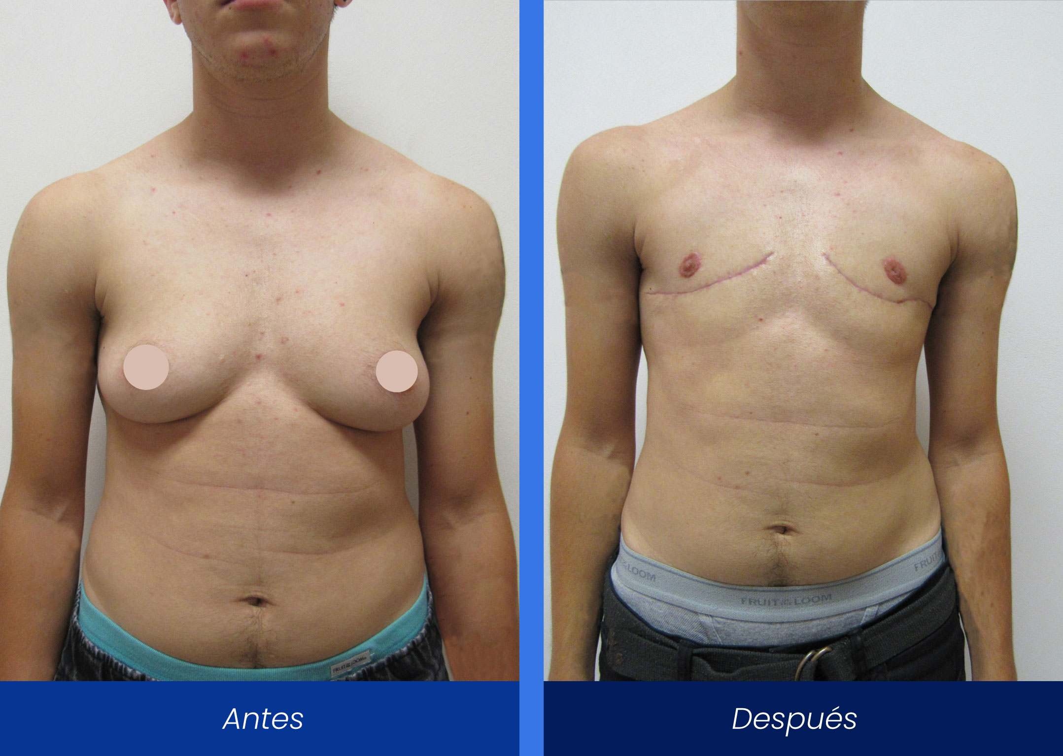 Masculinizacion-de-torax Masculinizacion-de-torax