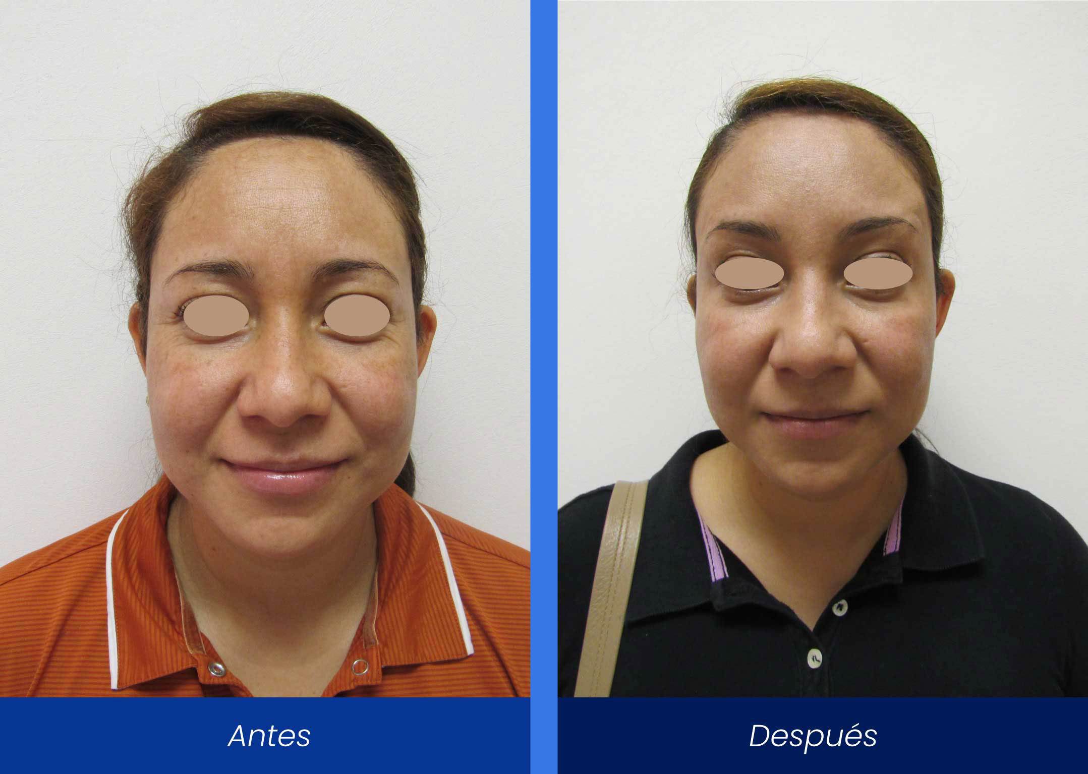 Aplicación de Botox Aplicación de Botox