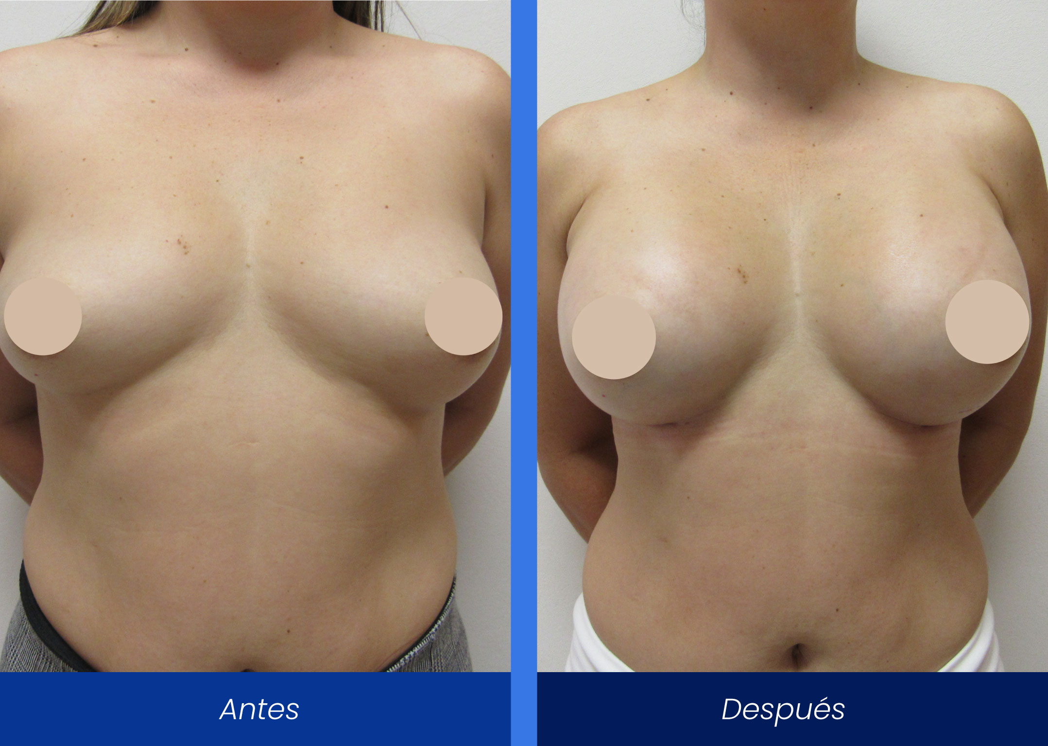 aumento de busto aumento de busto
