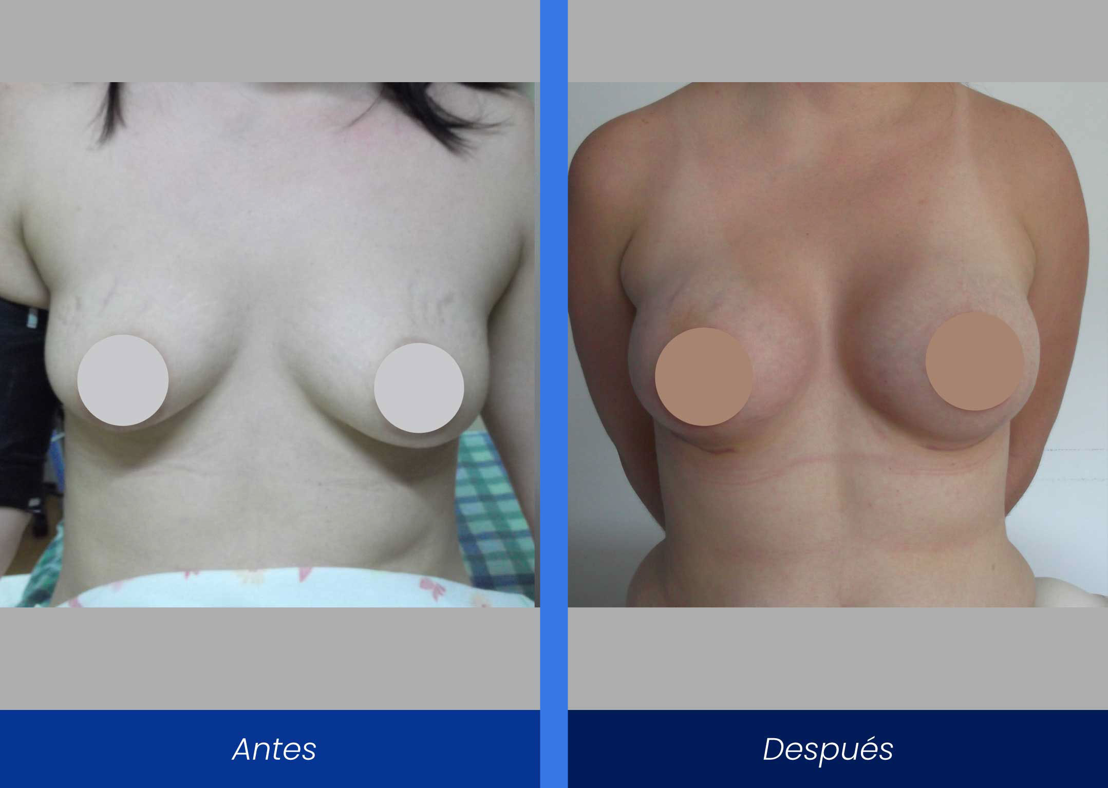 aumento de busto implantes subglandulares aumento de busto implantes subglandulares
