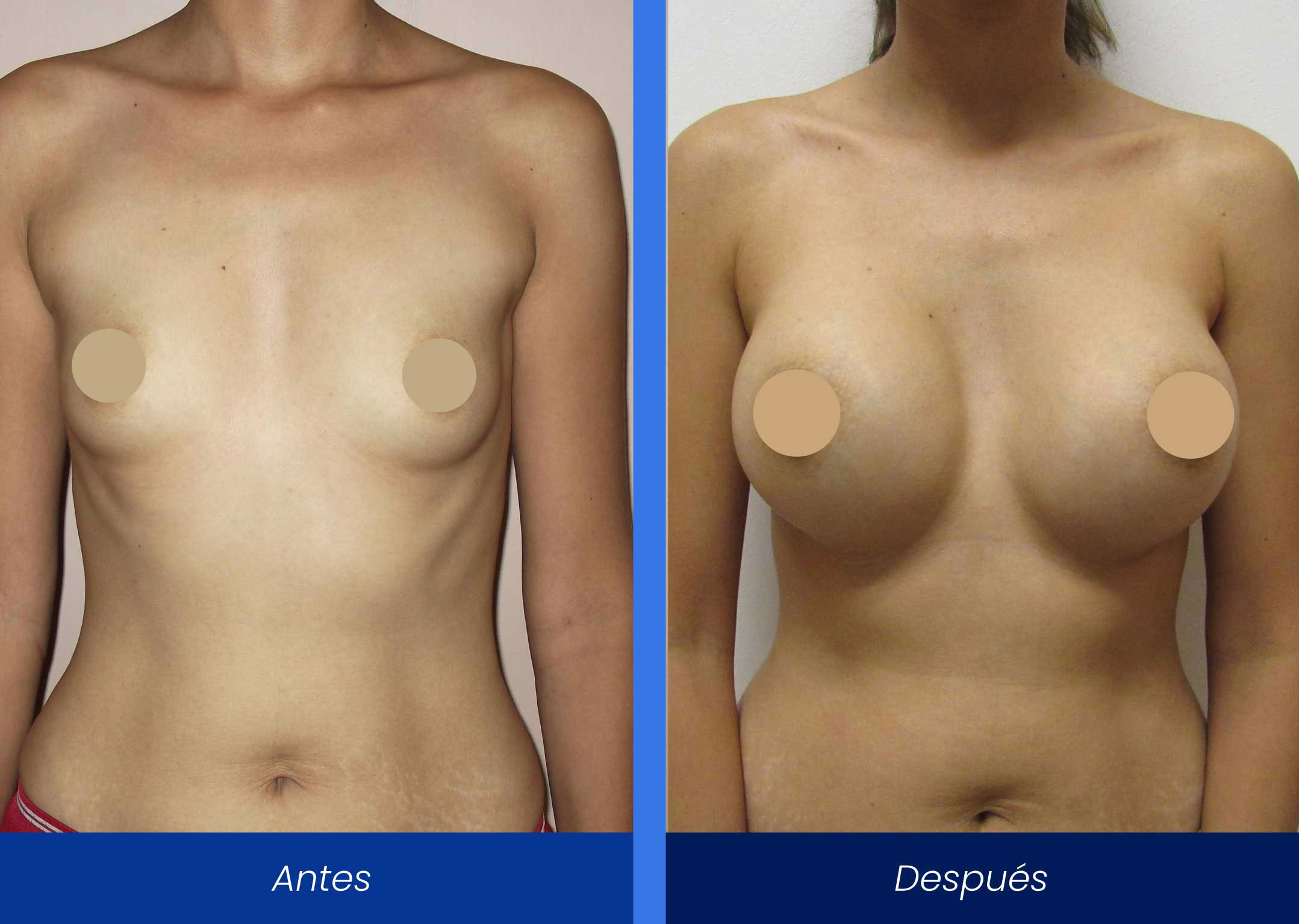 aumento de busto implantes submusculares aumento implantes submusculares