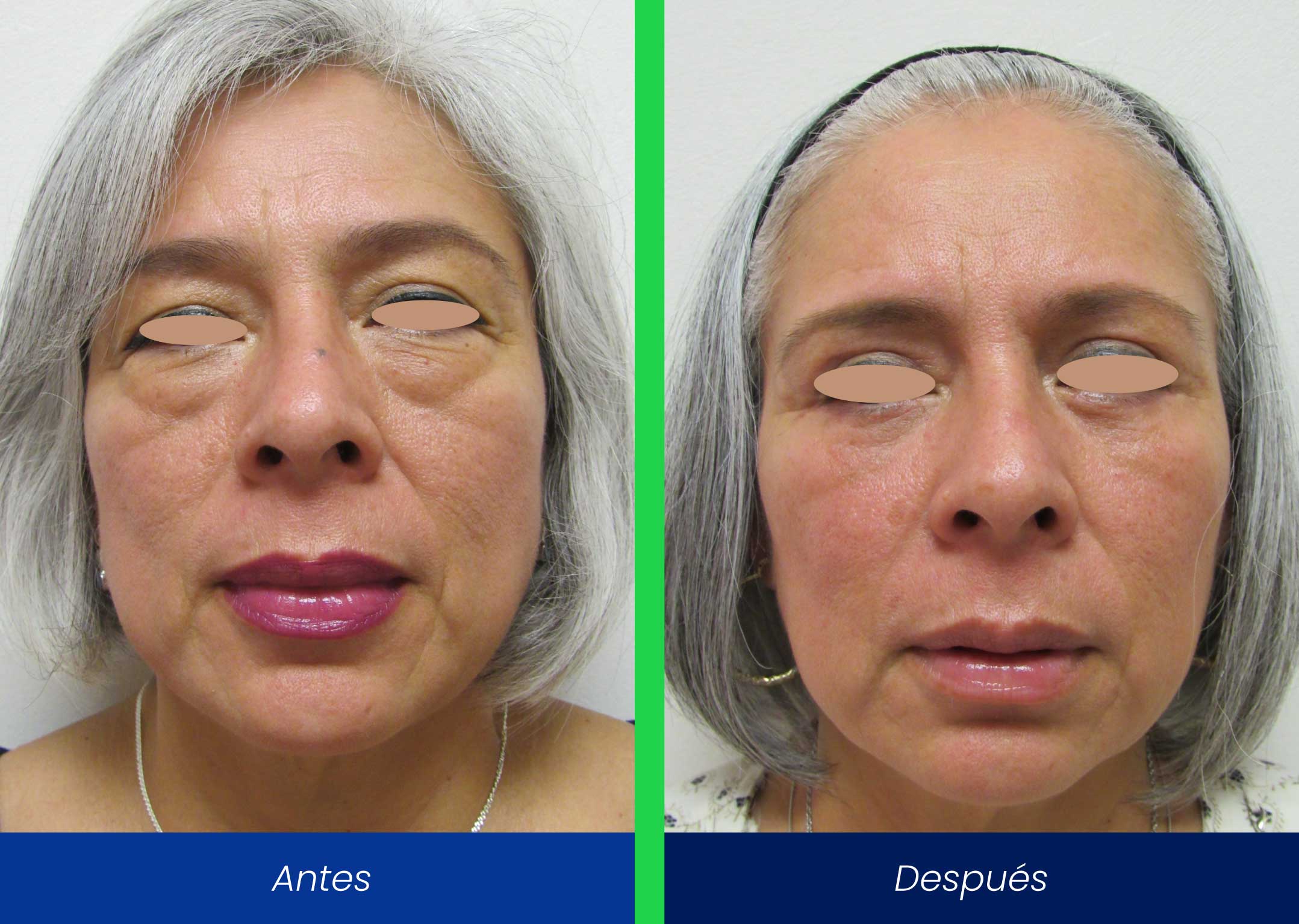 blefaroplastia blefaroplastia