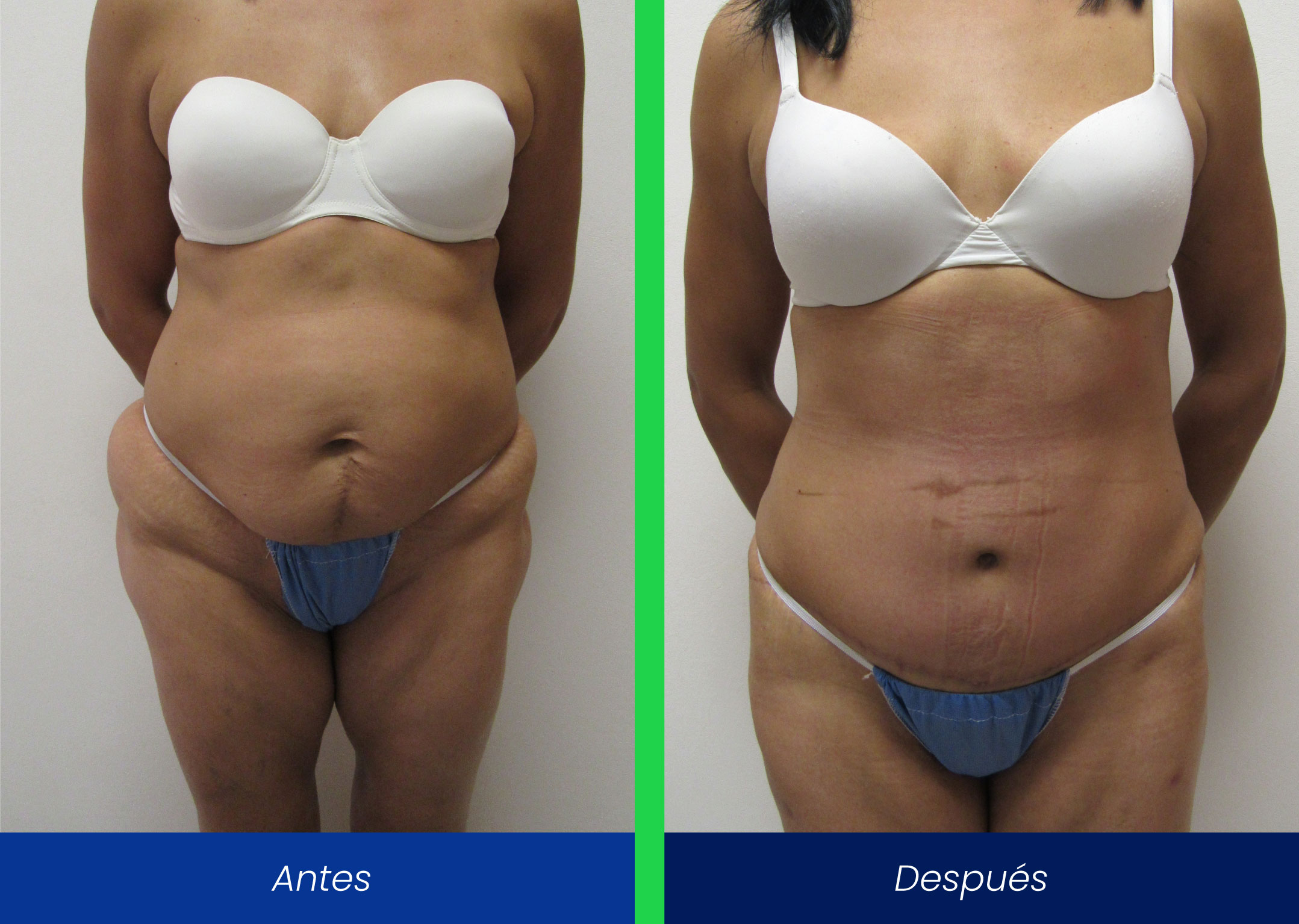 lipoabdominoplastía lipoabdominoplastía