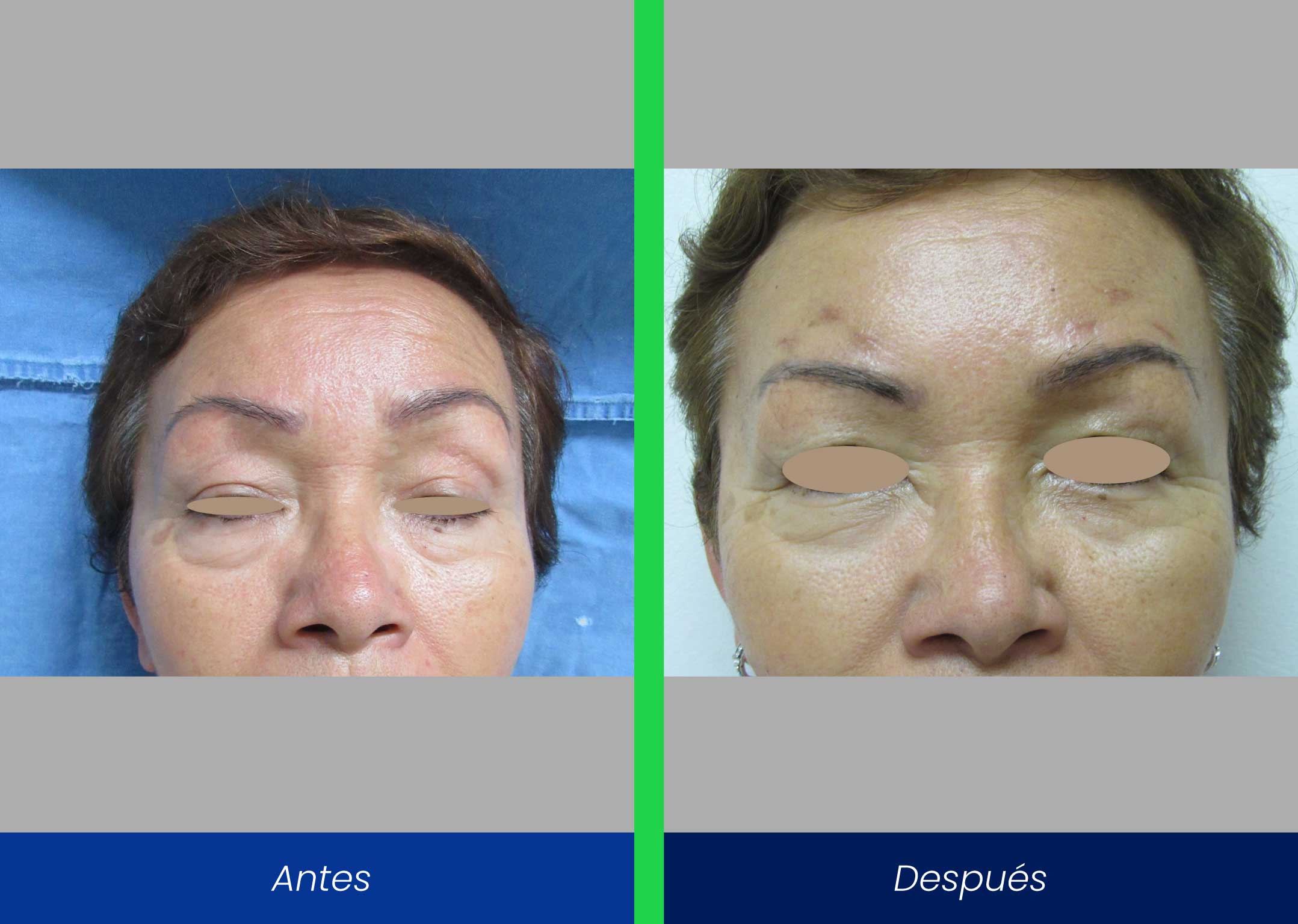 ptosis palpebral ptosis palpebral