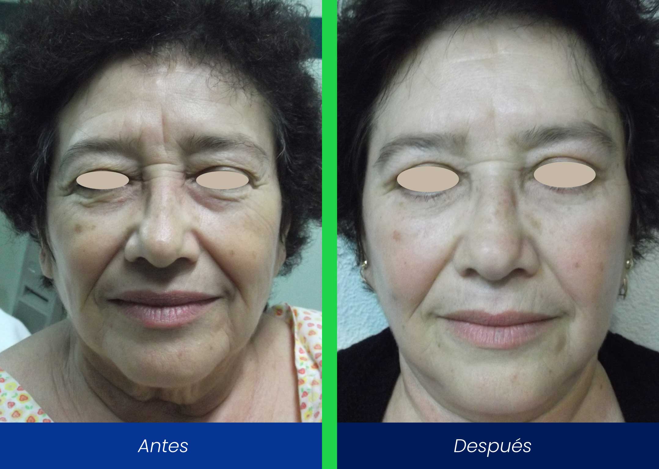 rejuvenecimiento facial rejuvenecimiento facial