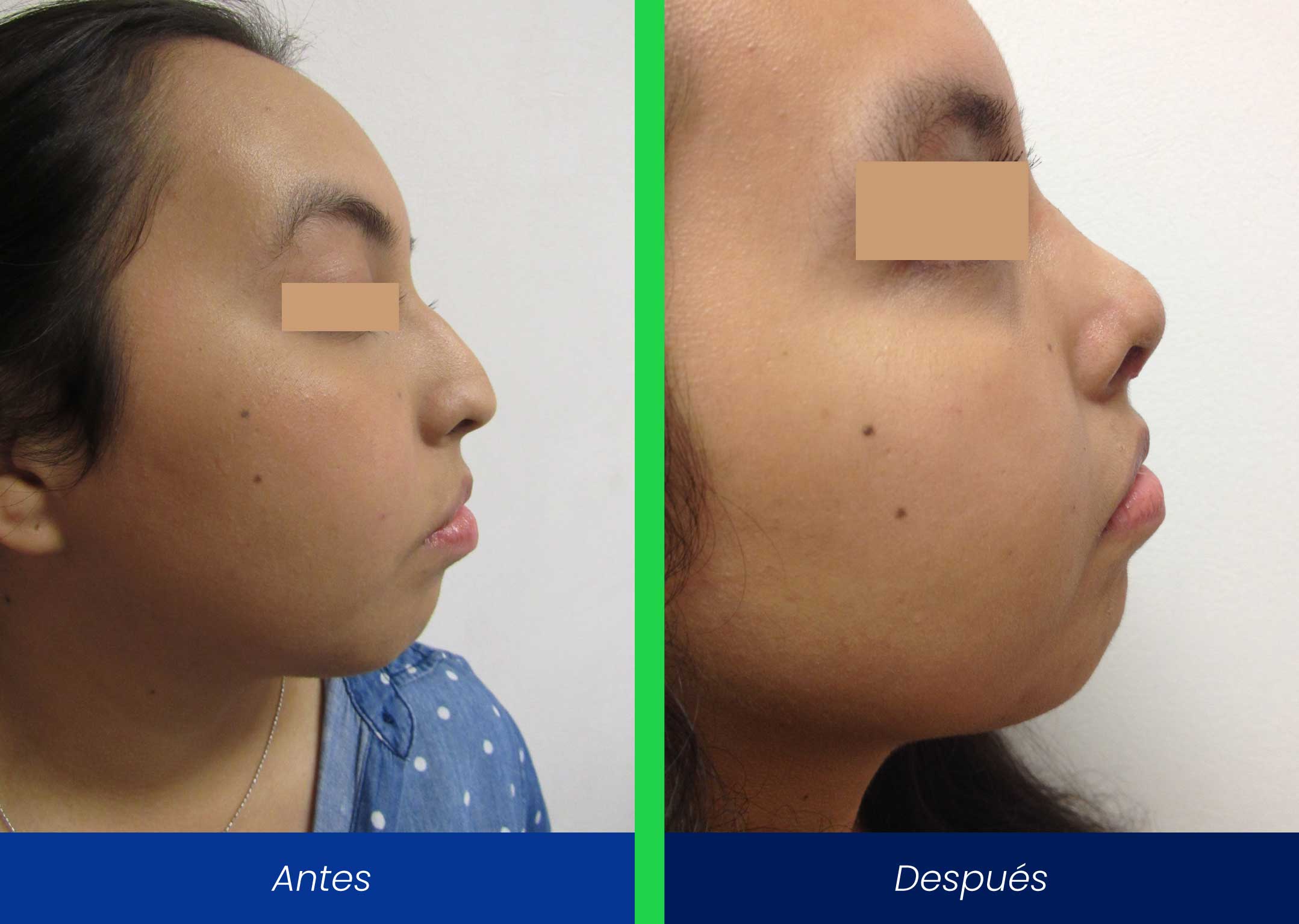 rinoplastia rinoplastia