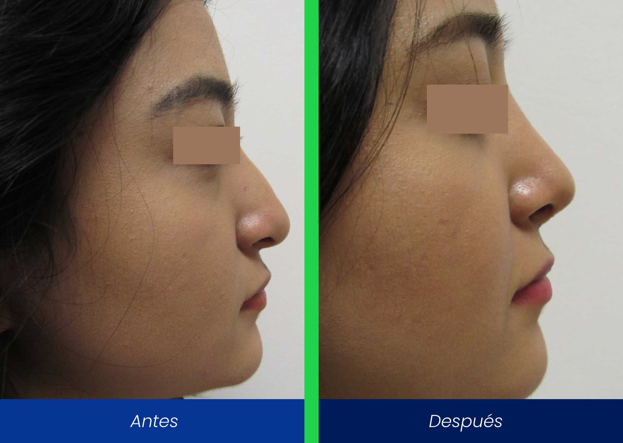 rinoplastia rinoplastia